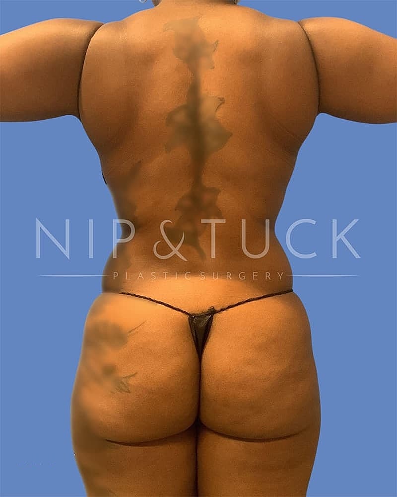 Mommy Makeover Before & After