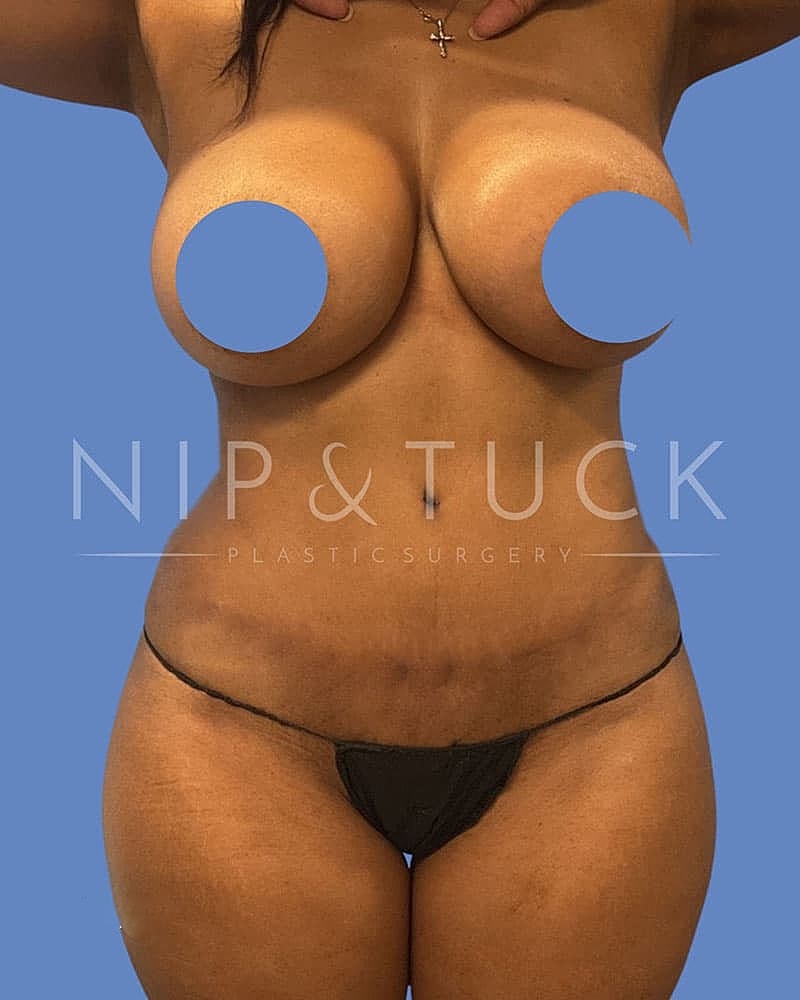 Mommy Makeover Before & After