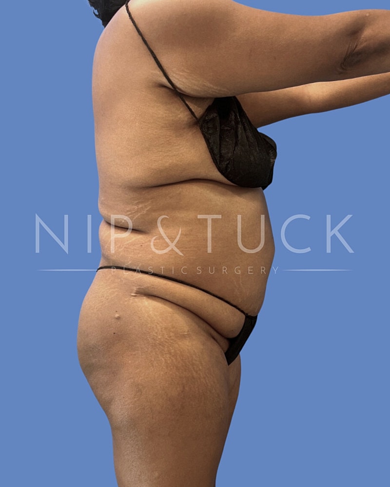 Skin Tightening Before & After