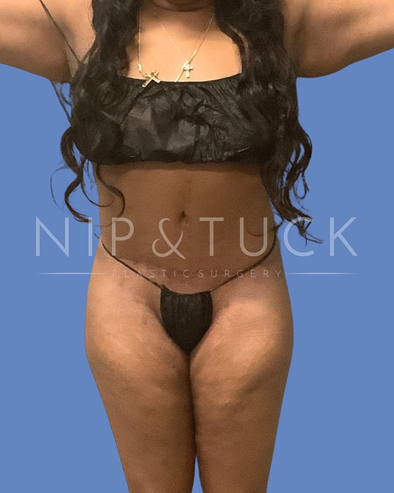 Skin Tightening Before & After