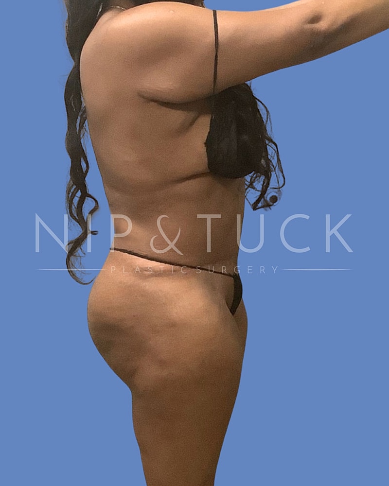 Skin Tightening Before & After