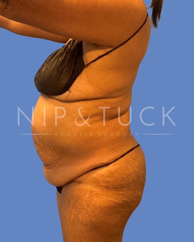 Skin Tightening Before & After