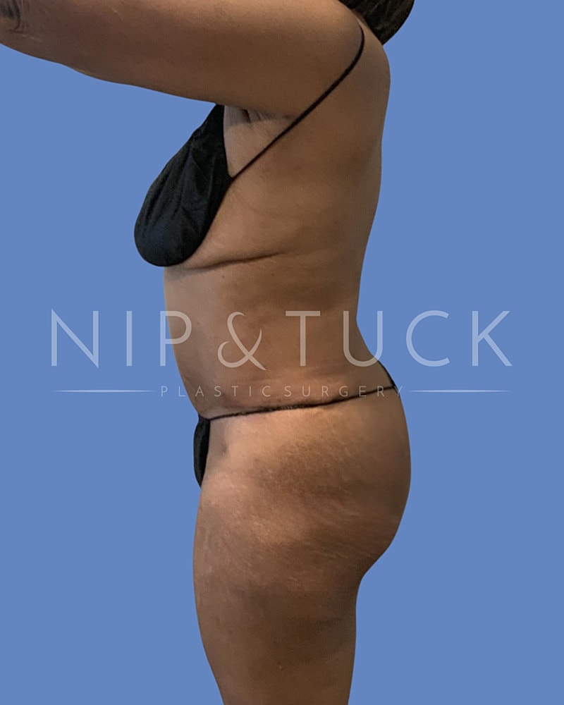 Skin Tightening Before & After
