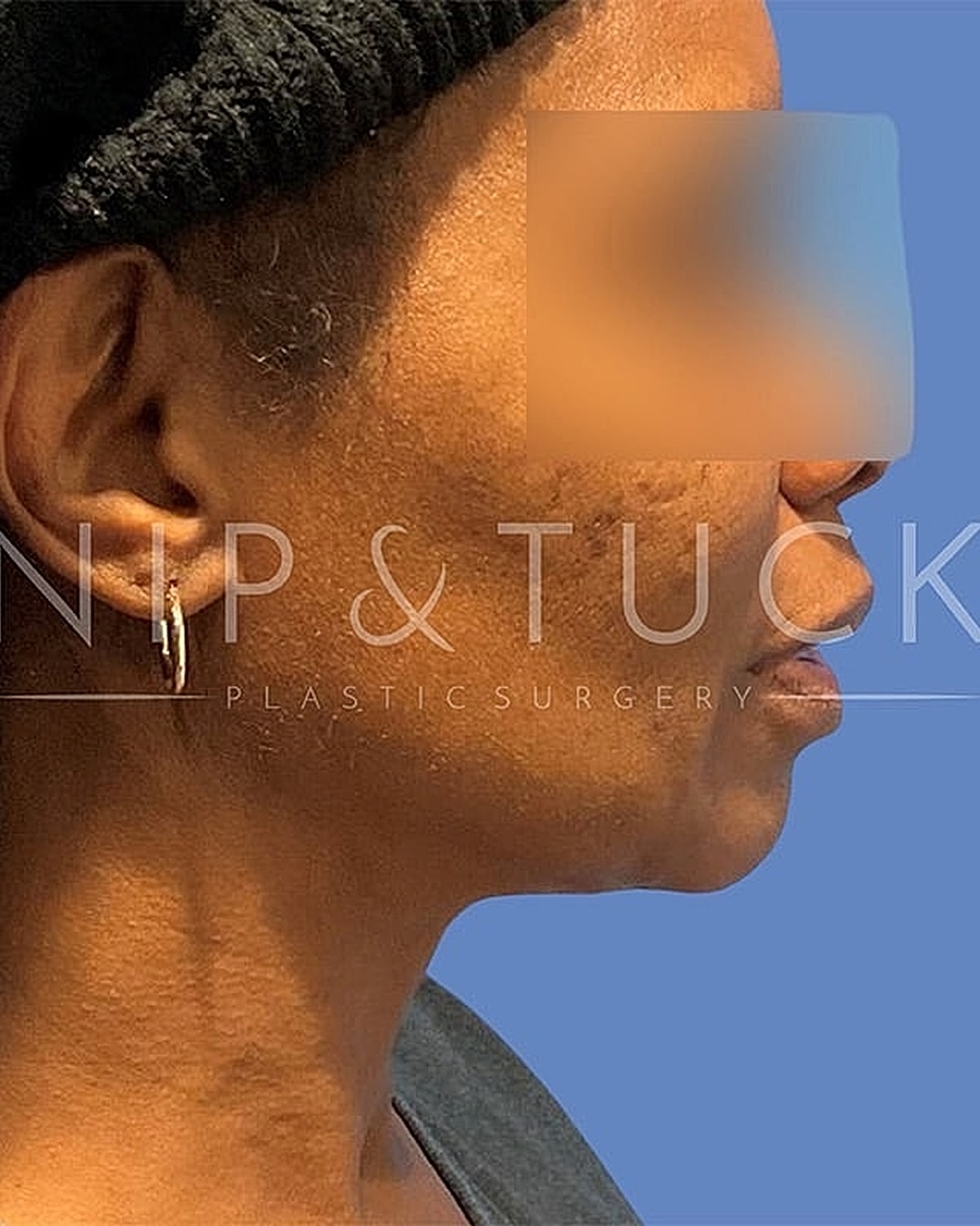 Skin Tightening Before & After