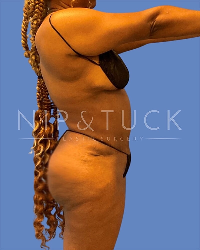 Skin Tightening Before & After