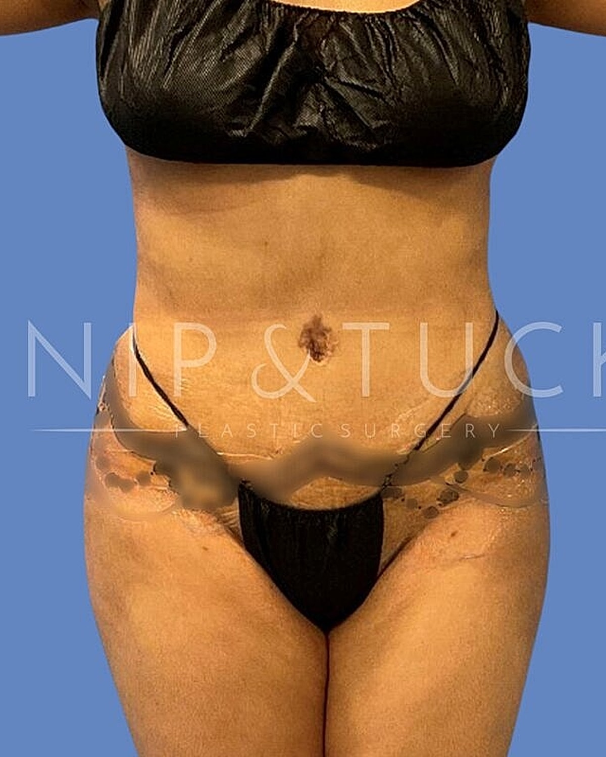 Skin Tightening Before & After