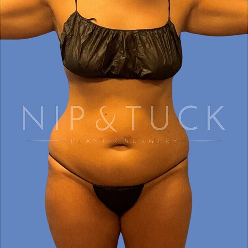 Skin Tightening Before & After