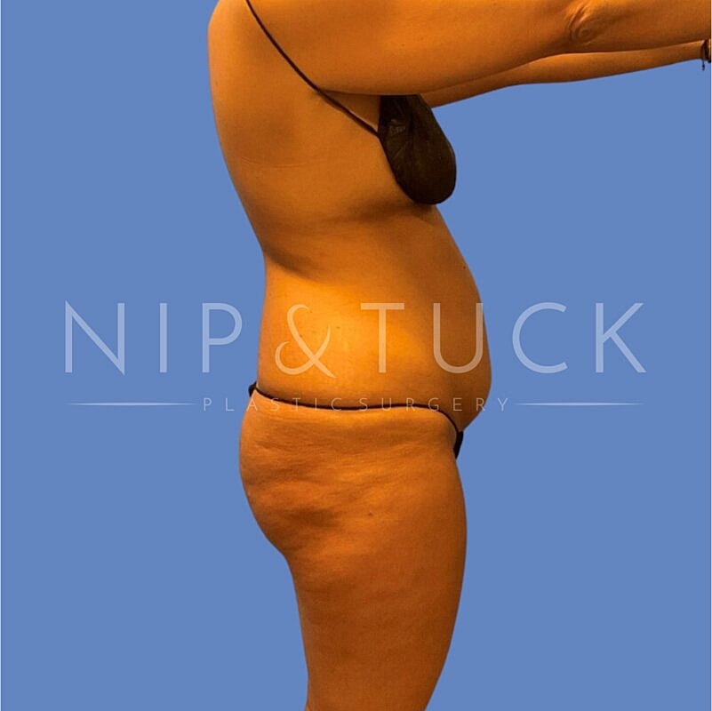 Skin Tightening Before & After