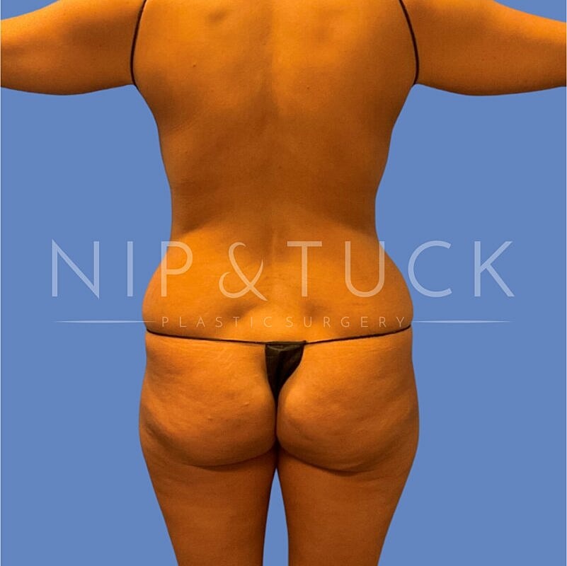 Skin Tightening Before & After