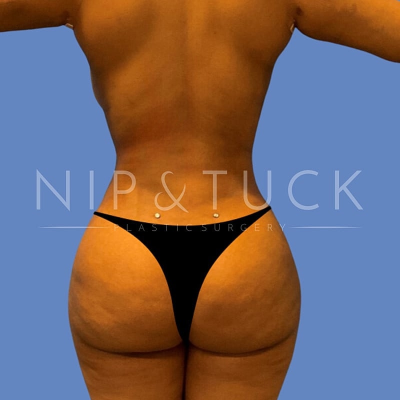 Skin Tightening Before & After
