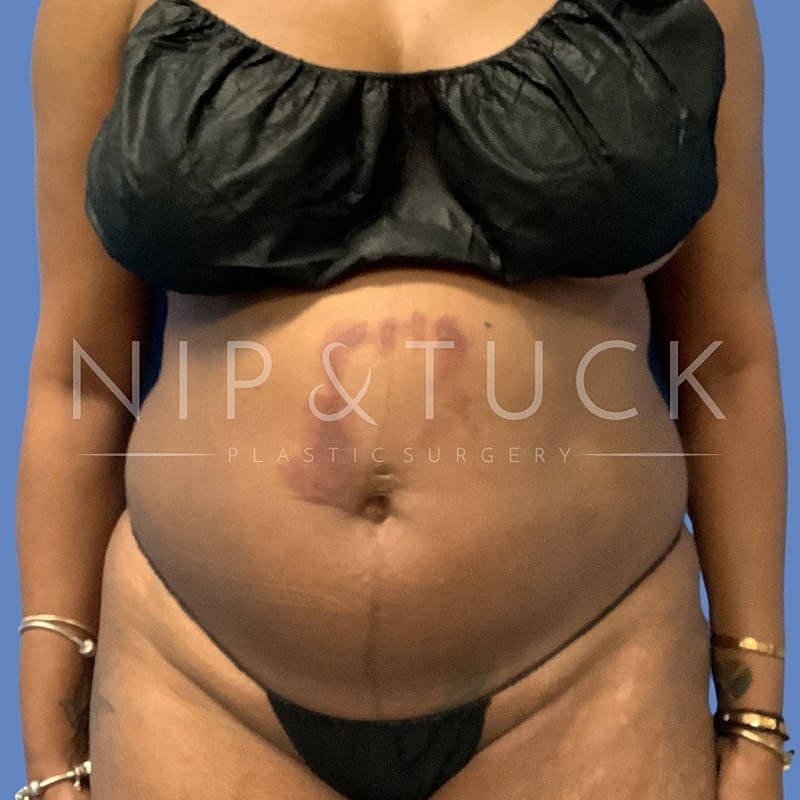 Skin Tightening Before & After