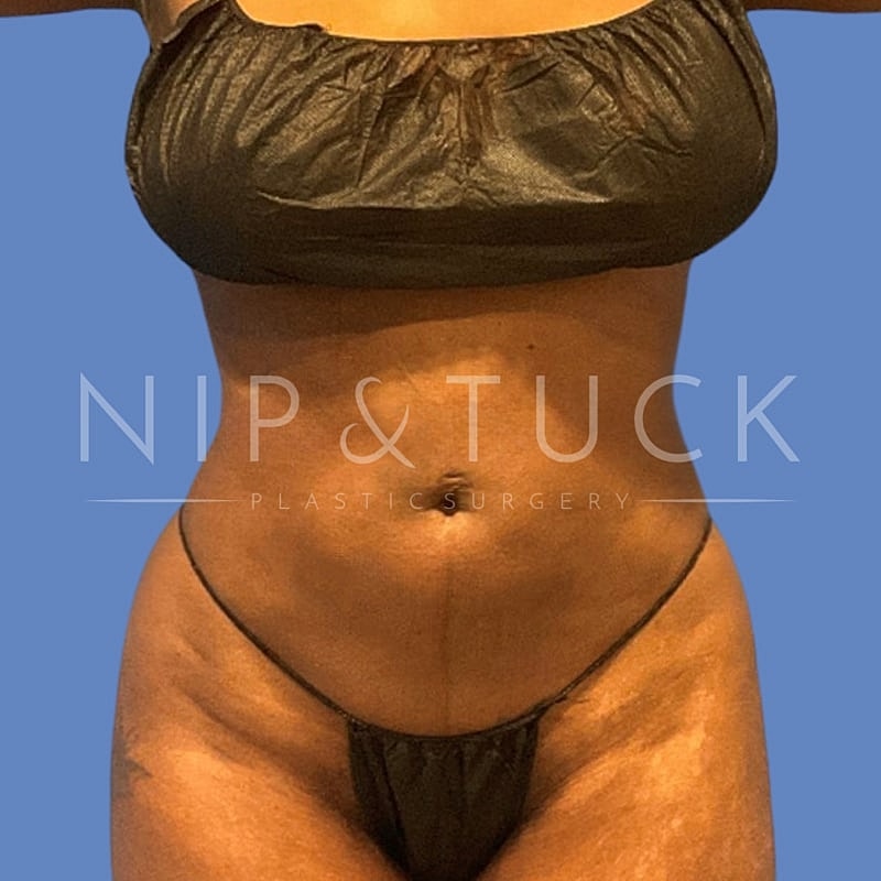 Skin Tightening Before & After