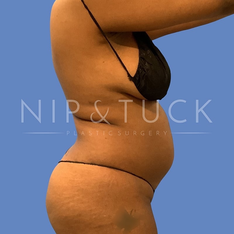 Skin Tightening Before & After