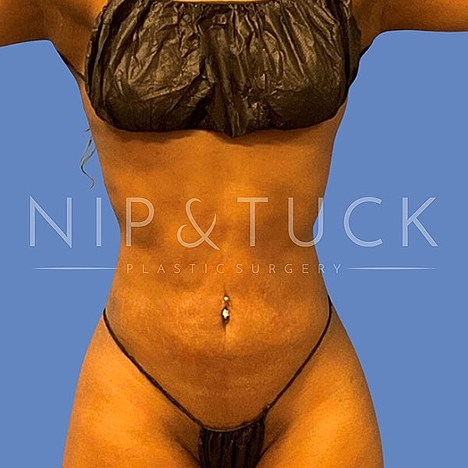 Skin Tightening Before & After