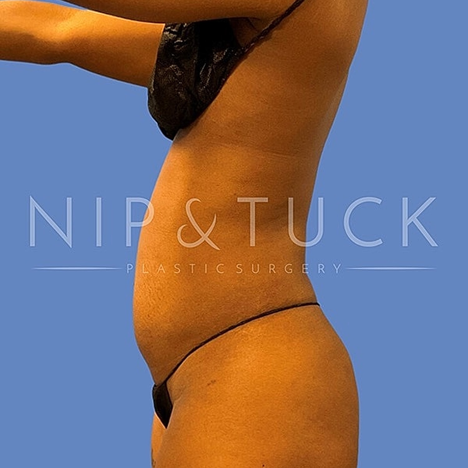 Skin Tightening Before & After