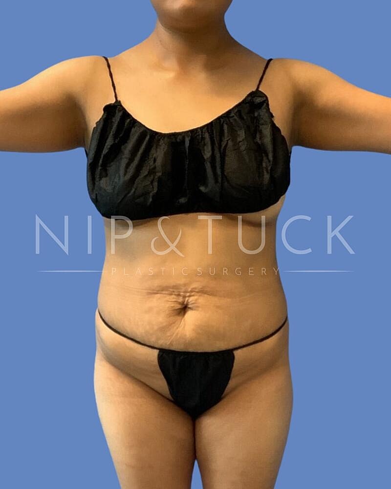 Skin Tightening Before & After