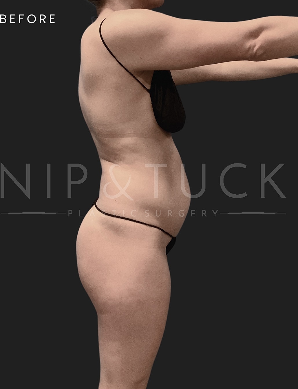 Renuvion Skin Tightening Before & After