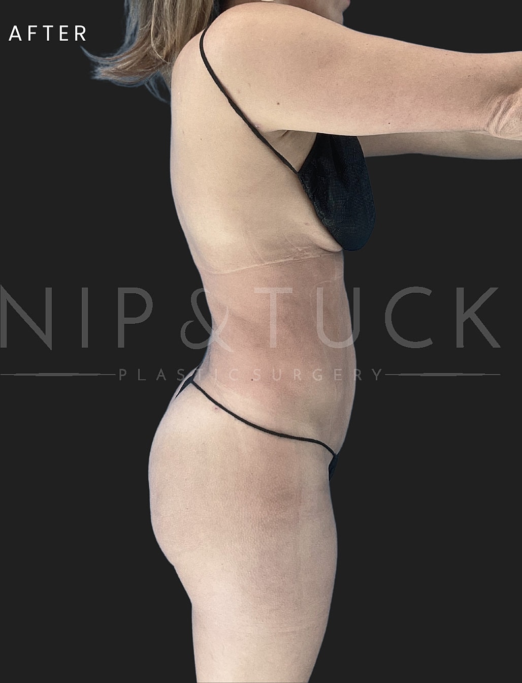 Renuvion Skin Tightening Before & After
