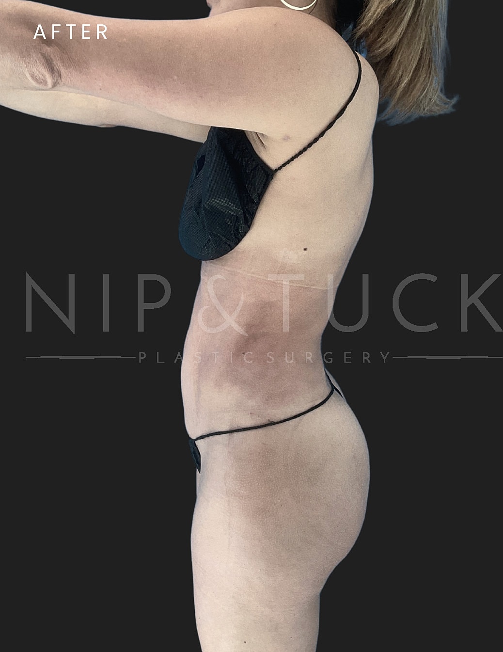 Renuvion Skin Tightening Before & After