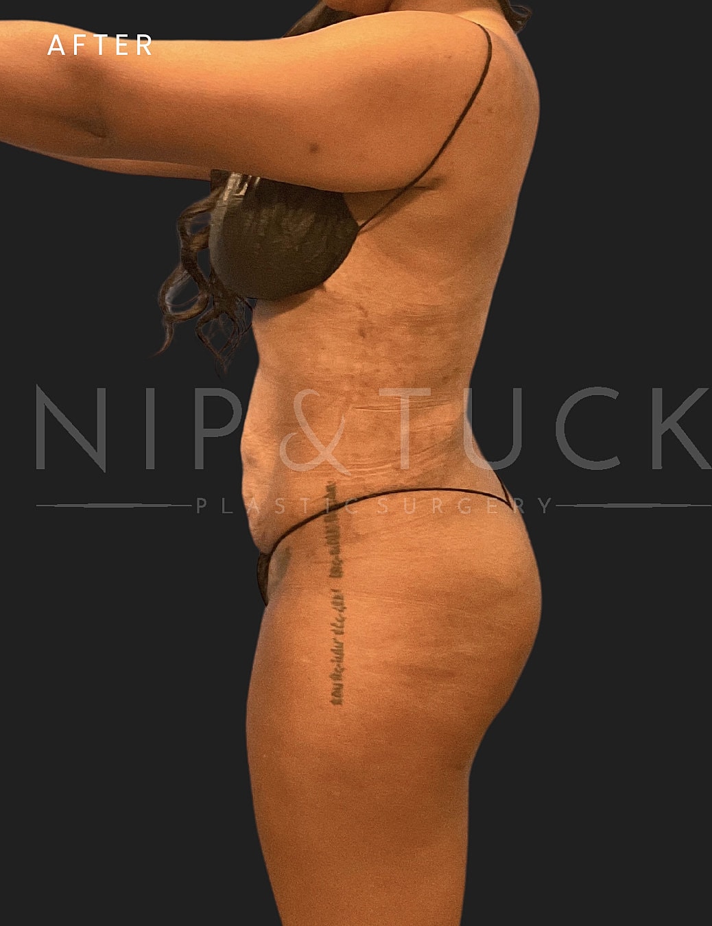 Renuvion Skin Tightening Before & After