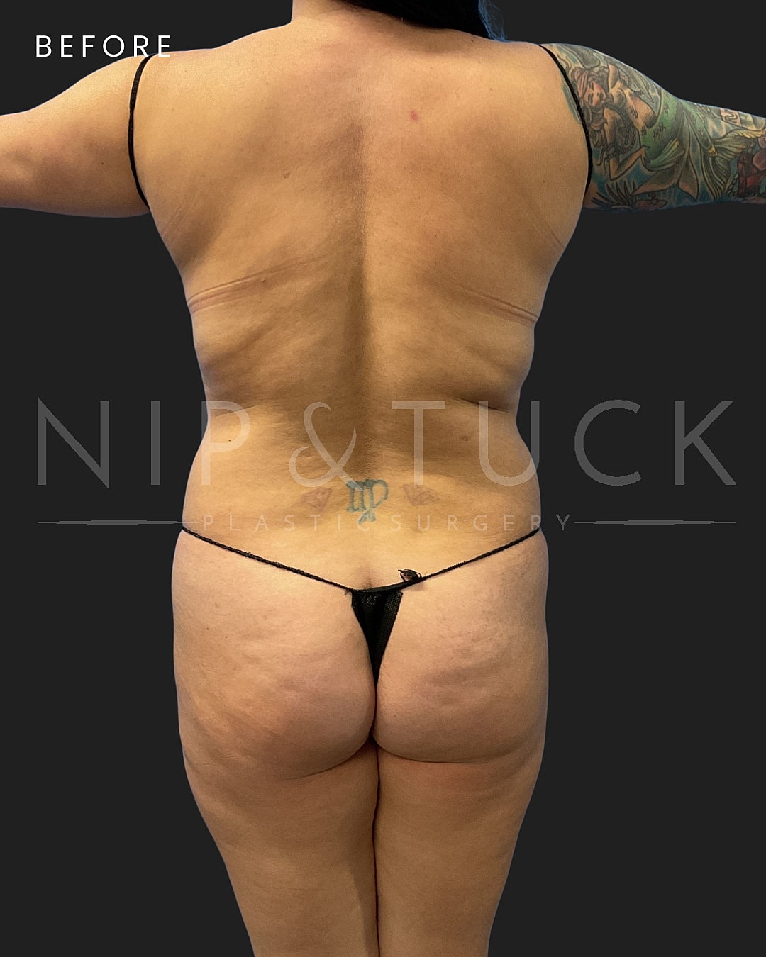 Renuvion Skin Tightening Before & After