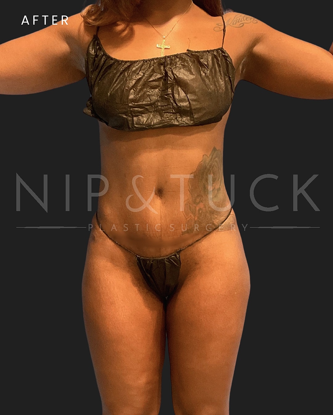 Renuvion Skin Tightening Before & After