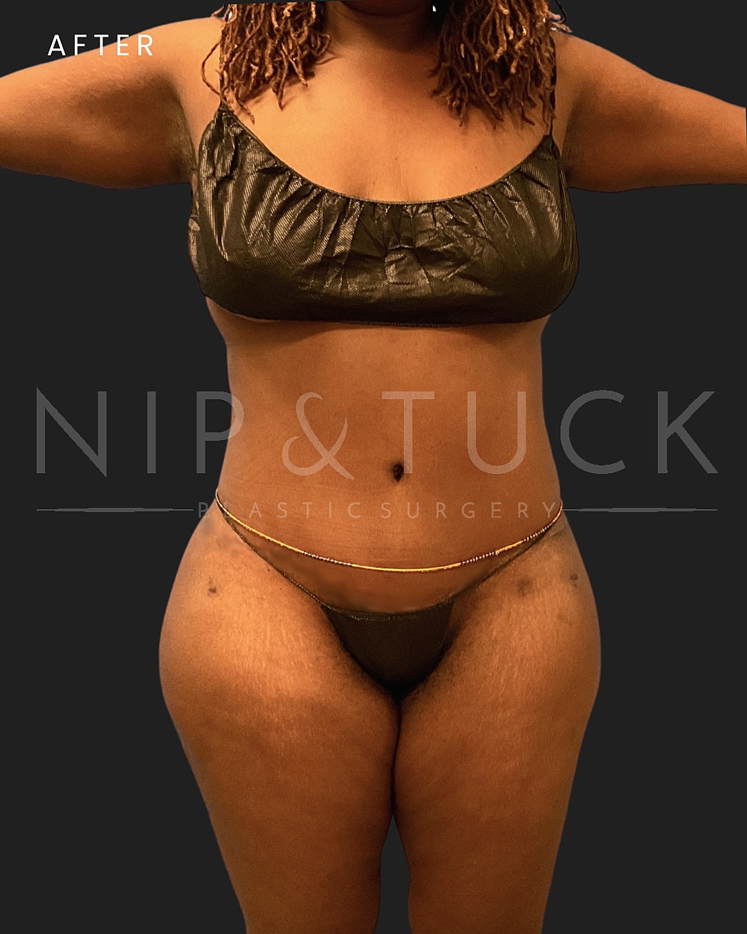 Renuvion Skin Tightening Before & After