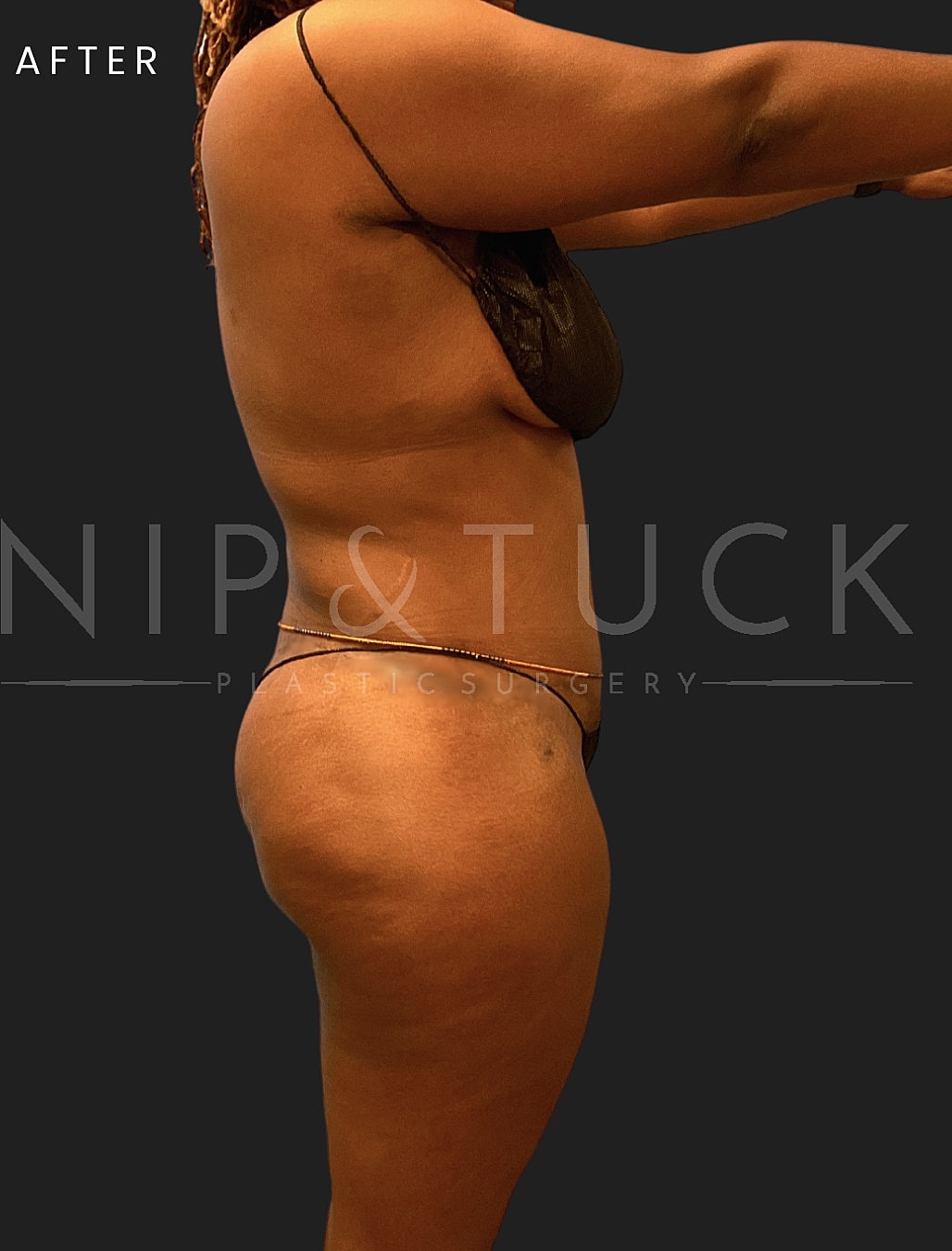 Renuvion Skin Tightening Before & After