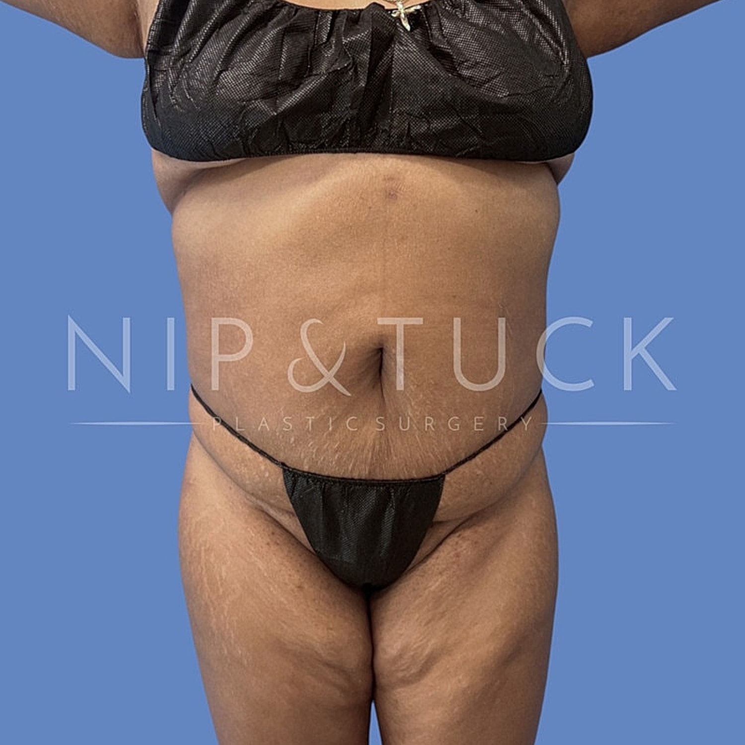 Model posing in swimwear for cosmetic surgery advertisement.