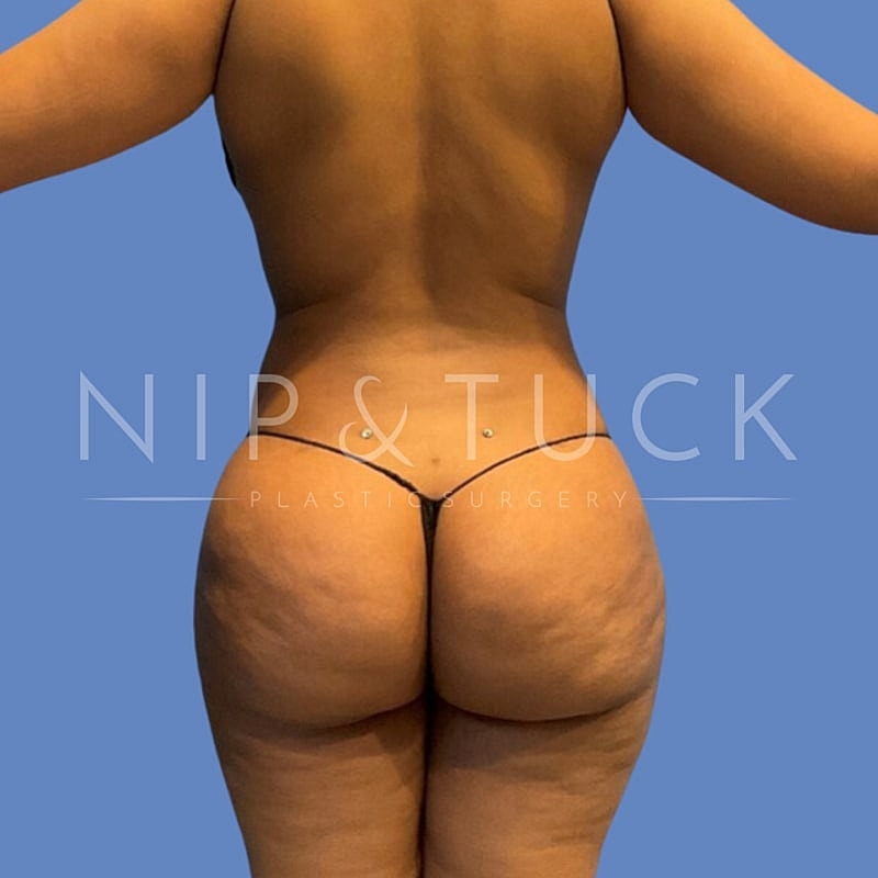 Awake Liposuction Before & After