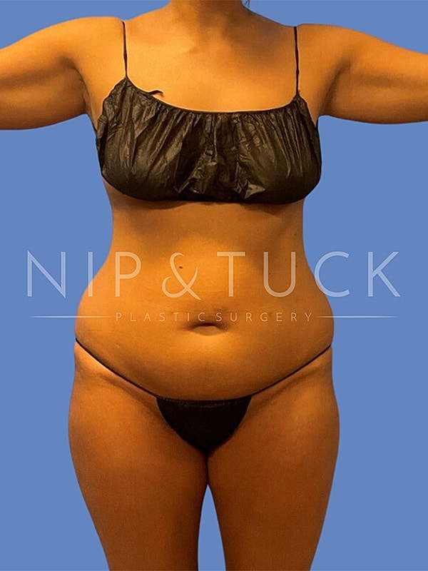 Awake Liposuction Before & After