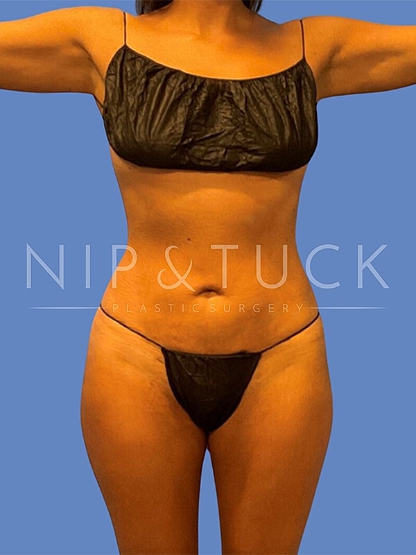 Awake Liposuction Before & After