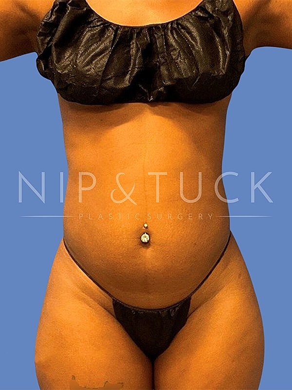 Awake Liposuction Before & After