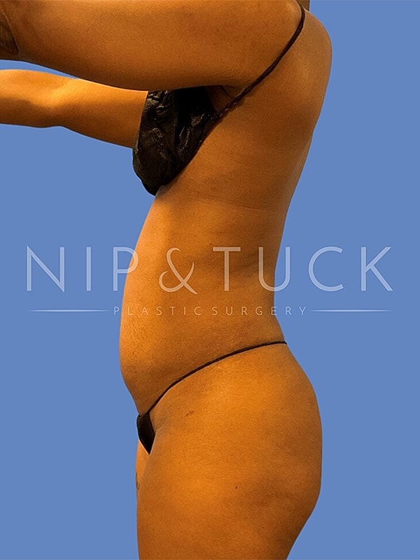 Awake Liposuction Before & After