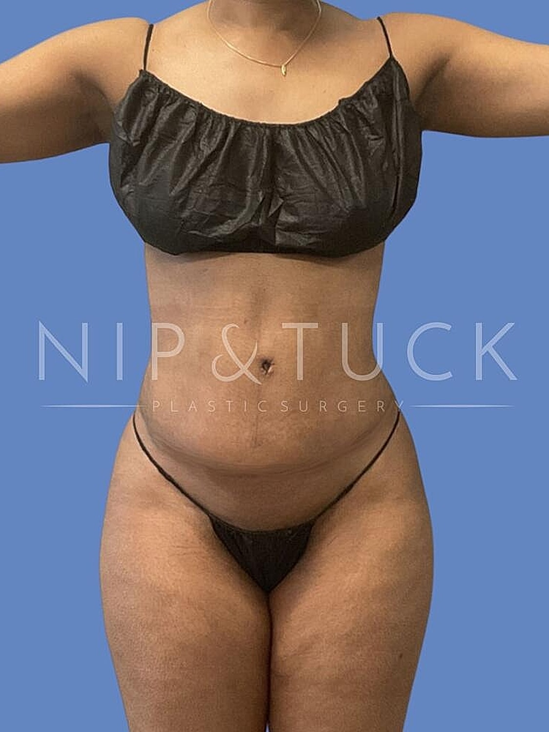 Awake Liposuction Before & After