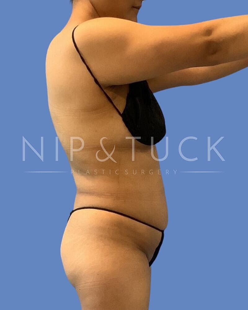 Awake Liposuction Before & After