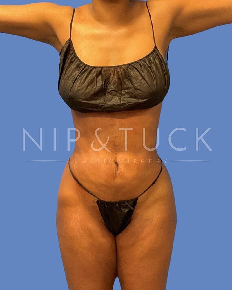 Awake Liposuction Before & After