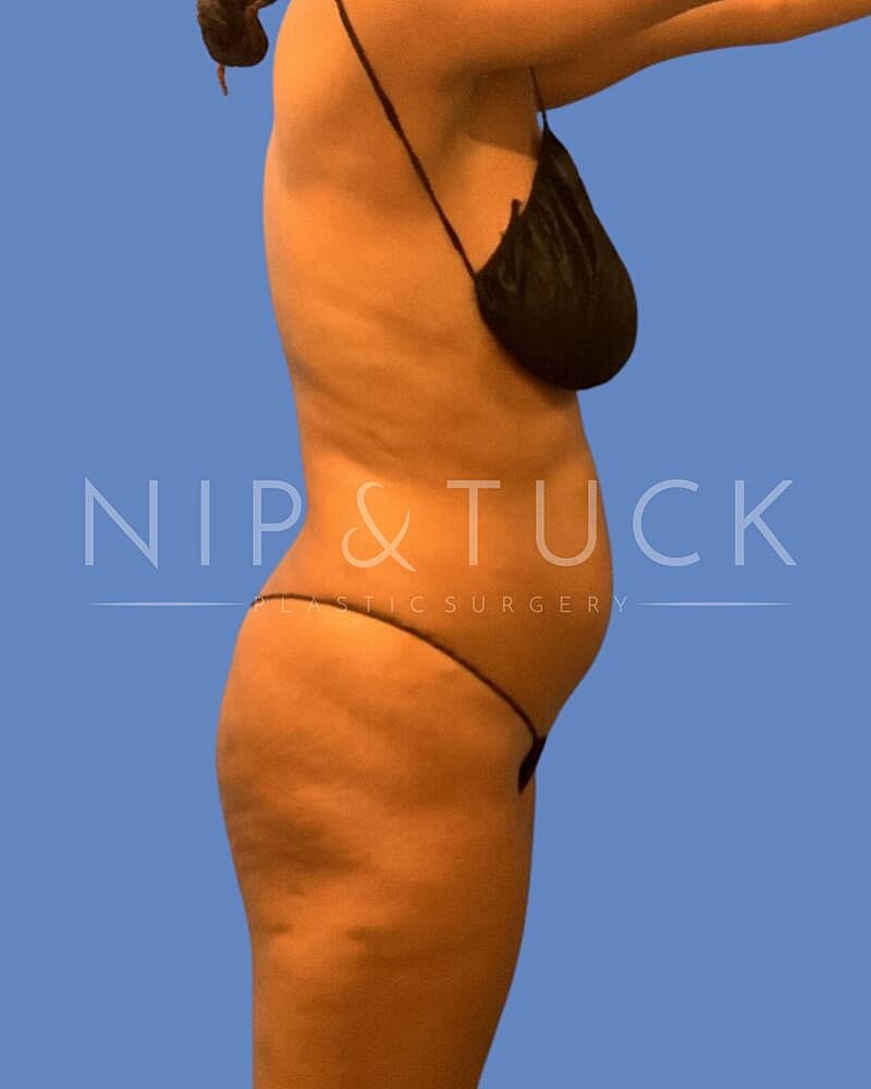 Awake Liposuction Before & After