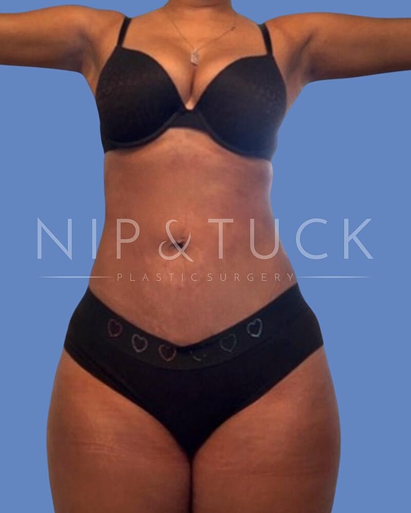 Awake Liposuction Before & After