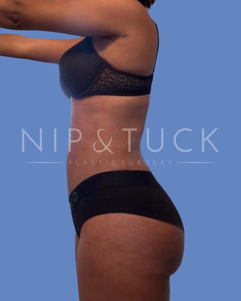 Awake Liposuction Before & After