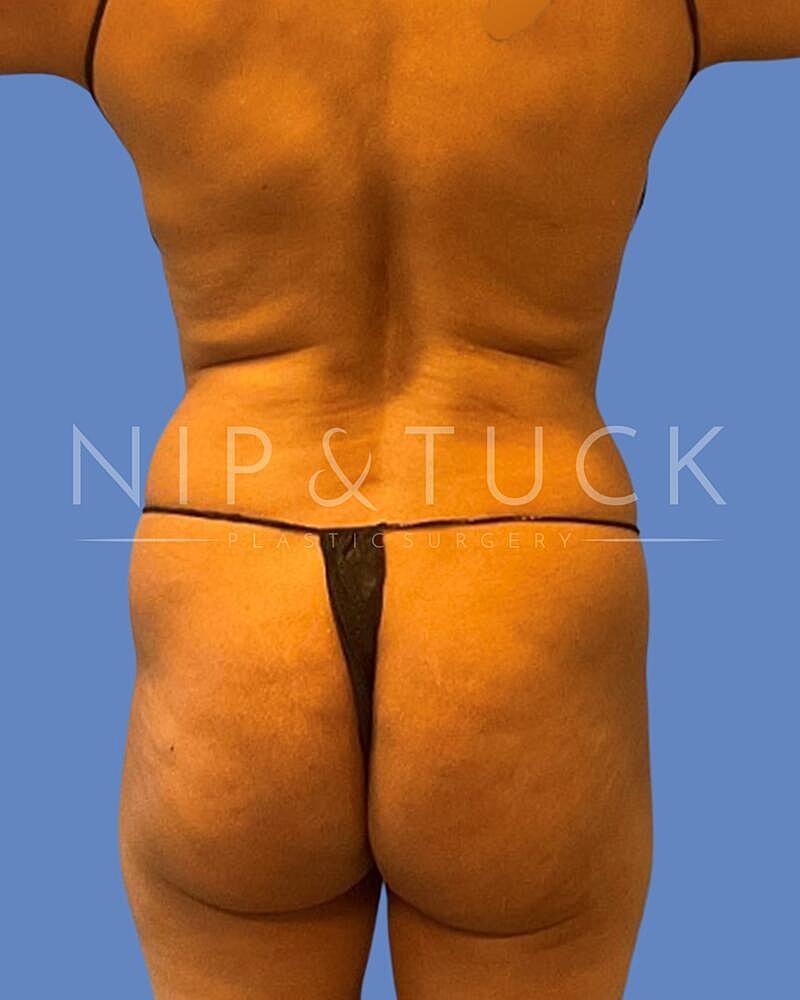 Awake Liposuction Before & After
