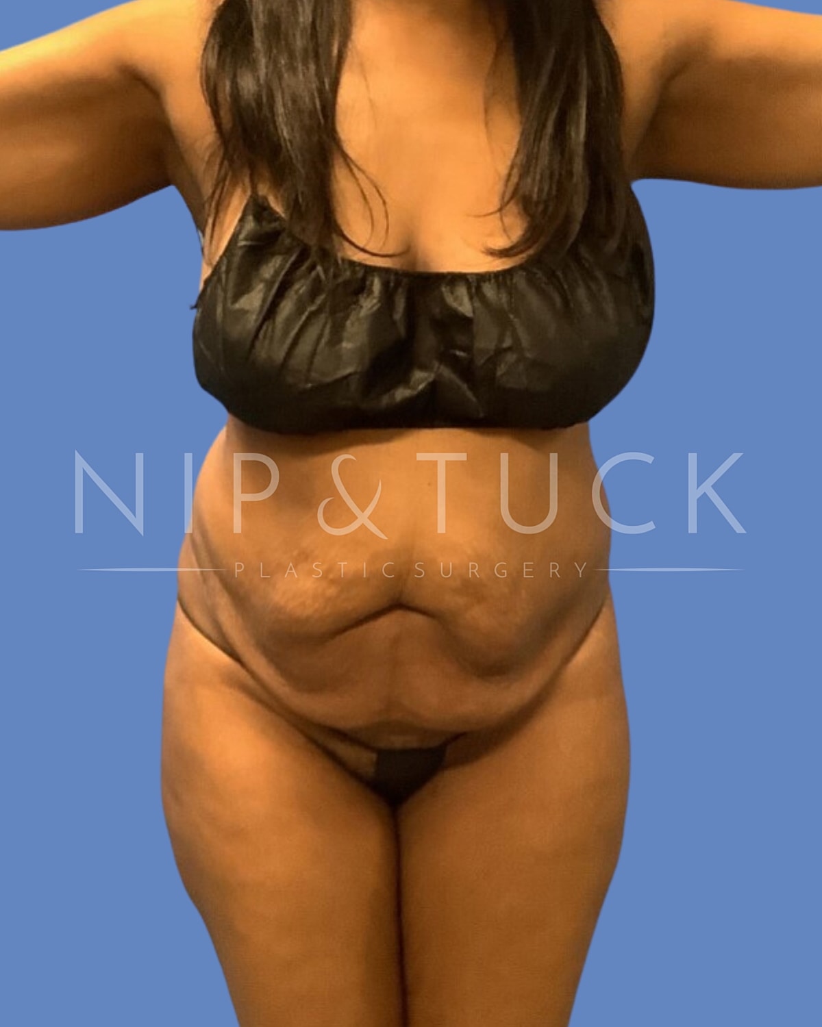 Awake Liposuction Before & After