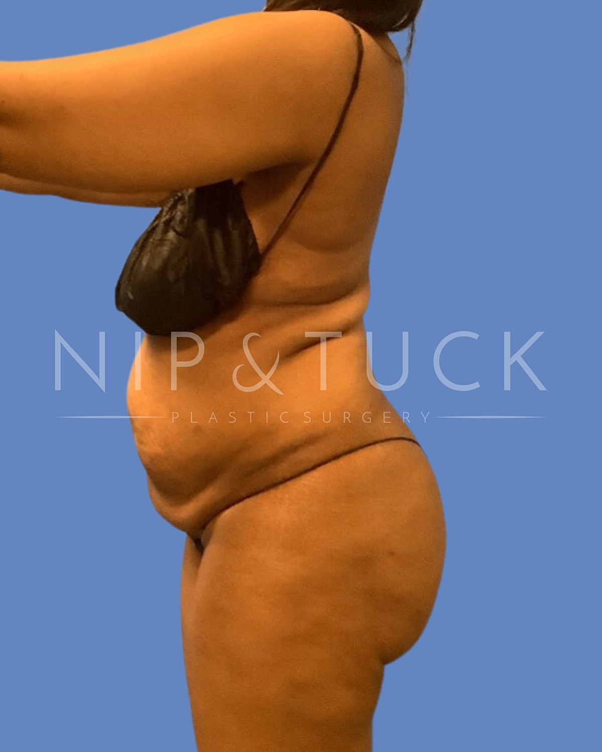 Awake Liposuction Before & After