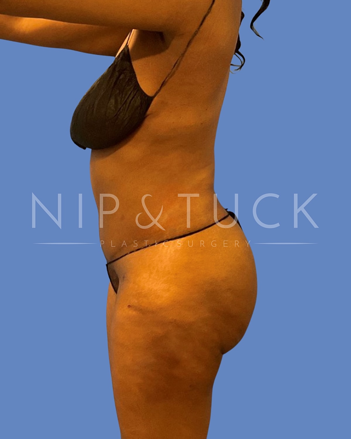 Awake Liposuction Before & After