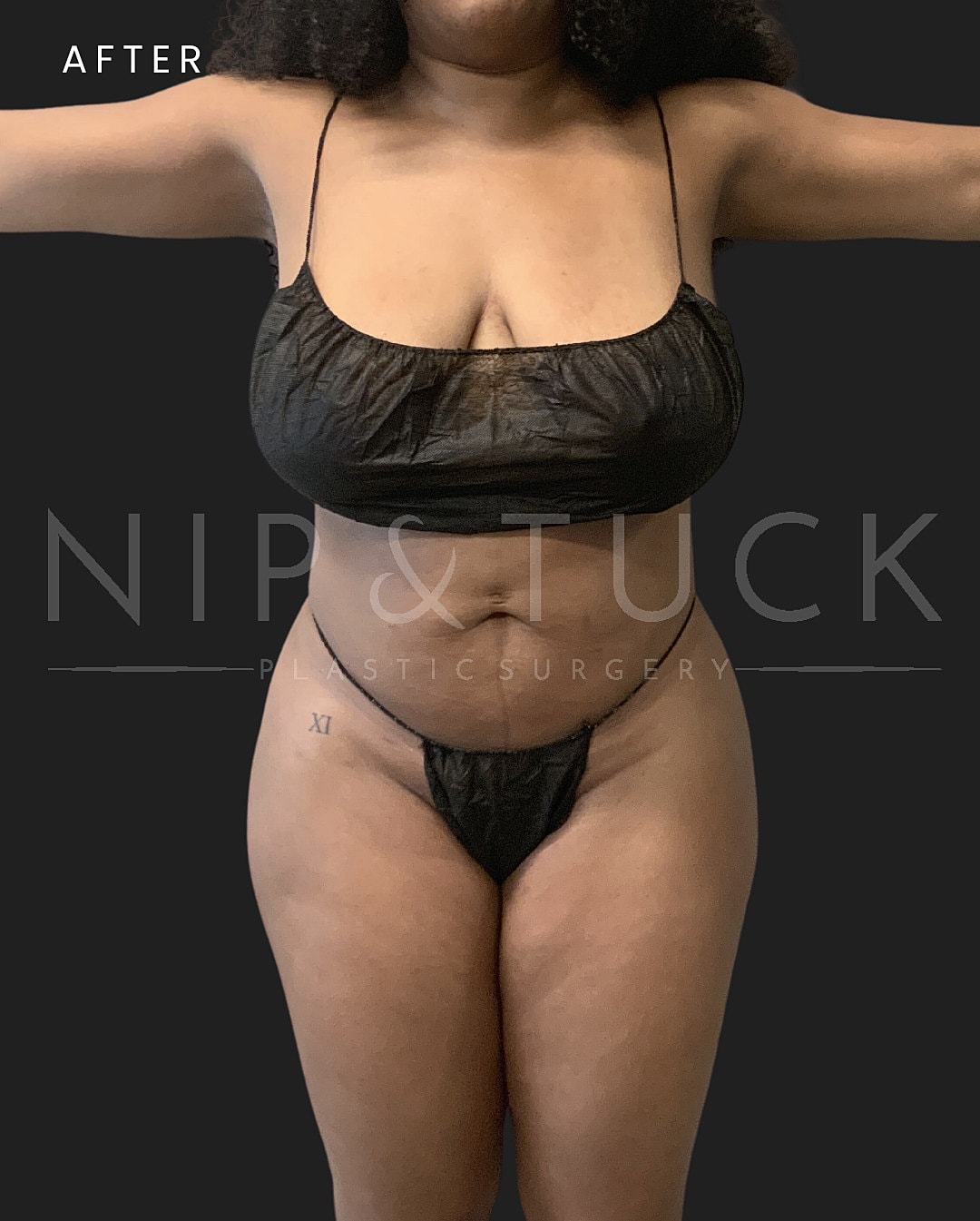 Awake Liposuction Before & After