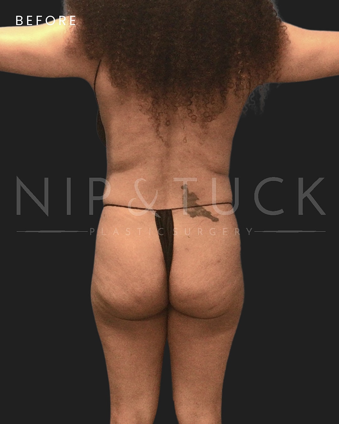 Awake Liposuction Before & After