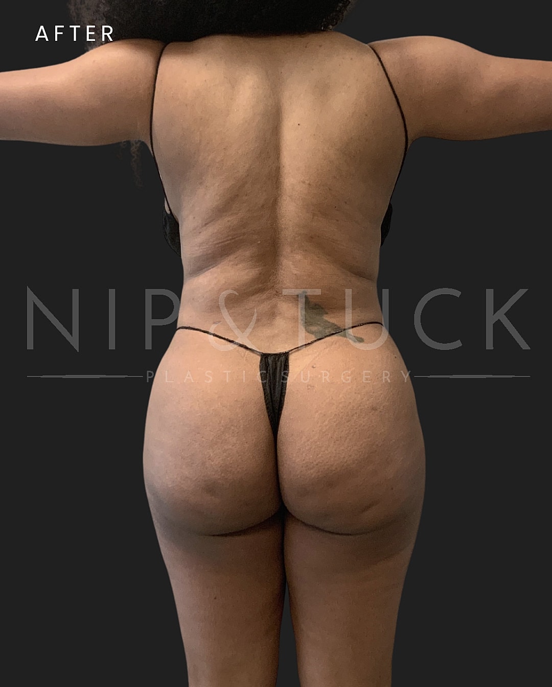 Awake Liposuction Before & After
