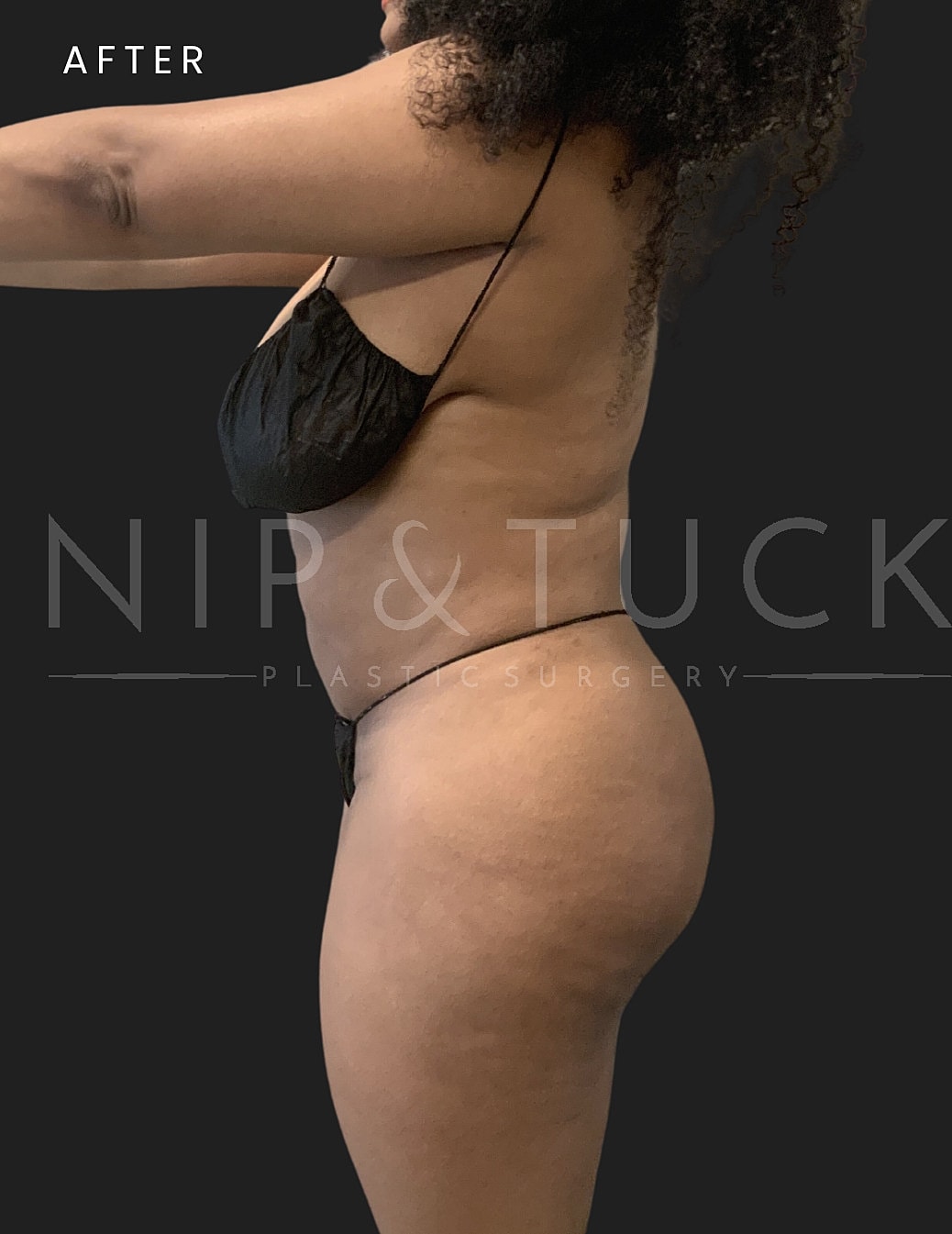 Awake Liposuction Before & After