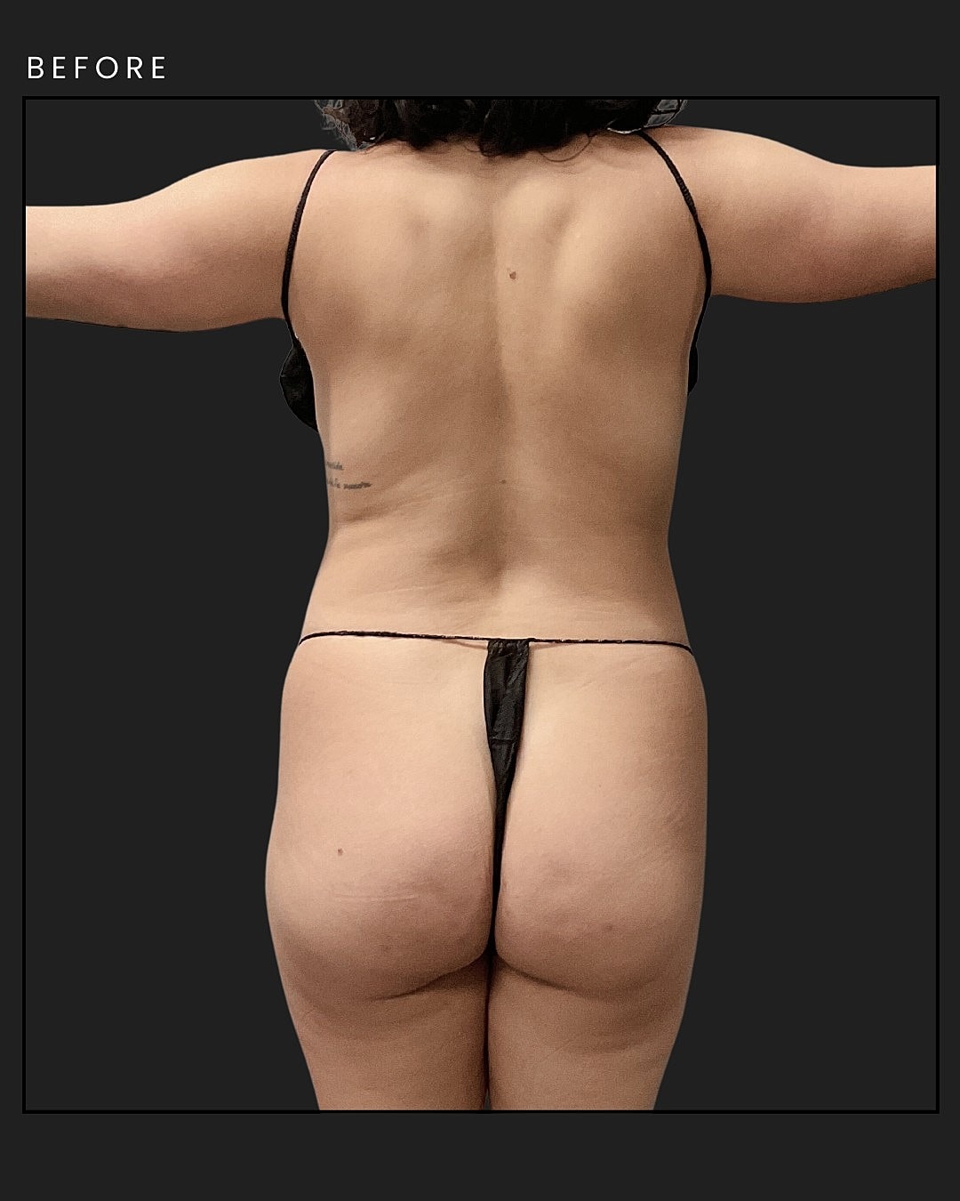 Awake Liposuction Before & After