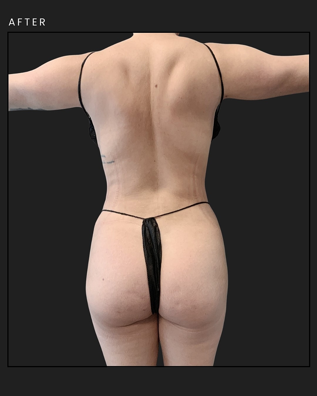 Awake Liposuction Before & After
